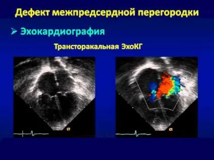 Дефект міжпередсердної перегородки (вроджений порок серця) - вторинний, операція, у новонароджених