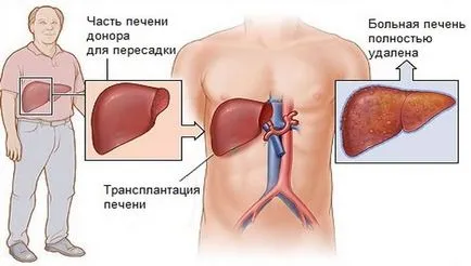 Як проводиться і скільки коштує пересадка печінки в китаї (проводиться) Як проводиться і скільки коштує пересадка печінки в китаї