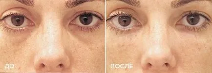 Як прибрати западини під очима - модна красива