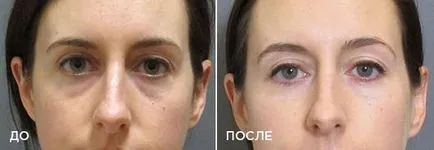 Як прибрати западини під очима - модна красива