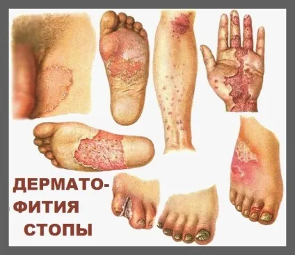дерматофітіях стопи