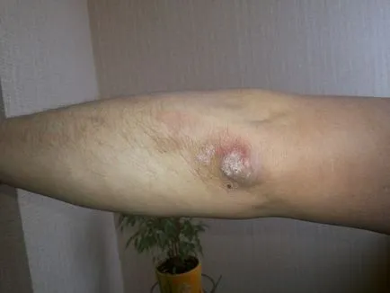 Як я живу і борюся з псоріазом на ліктях (ліктях) Як я живу і борюся з псоріазом на ліктях