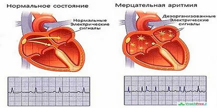 Кардіогенний шок при інфаркті міокарда що це таке, симптоми і перша допомога (міокарда) Кардіогенний шок при інфаркті міокарда що це таке, симптоми і перша допомога