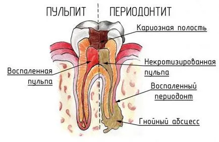Карієс симптоми, як розпізнати, причини, стадії розвитку, способи лікування (розвитку) Карієс симптоми, як розпізнати, причини, стадії розвитку, способи лікування