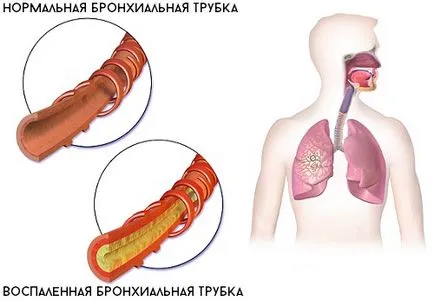 Кашель до блювоти у дорослого як допомогти пацієнтові без препаратів