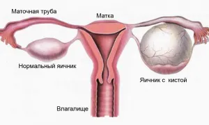 Кистома яєчників (лівого і правого) що це таке і чим відрізняється від кісти (яєчників) Кистома яєчників (лівого і правого) що це таке і чим відрізняється від кісти