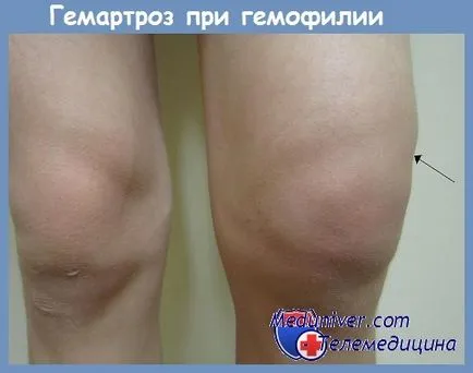 клініка гемофілії