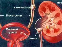 Корінь соняшнику від каменів в нирках рецепт лікування соняшником (каменів) Корінь соняшнику від каменів в нирках рецепт лікування соняшником