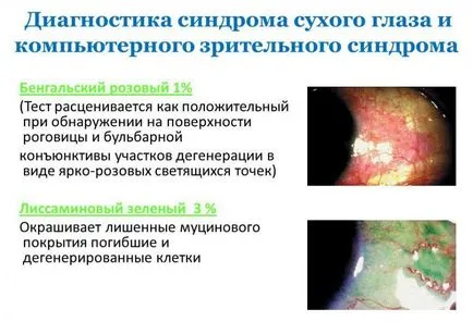 Комп'ютерний зоровий синдром - симптоми і лікування
