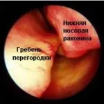 Кістковий гребінь в носі фото, відгуки, методи (носі) Кістковий гребінь в носі фото, відгуки, методи