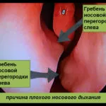 Кістковий гребінь в носі фото, відгуки, методи (носі) Кістковий гребінь в носі фото, відгуки, методи