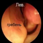Кістковий гребінь в носі фото, відгуки, методи (гребінь) Кістковий гребінь в носі фото, відгуки, методи