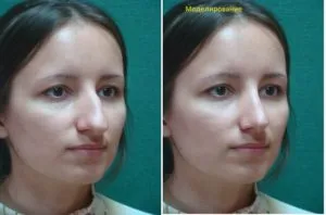 Кістковий гребінь в носі фото, відгуки, методи (гребінь) Кістковий гребінь в носі фото, відгуки, методи