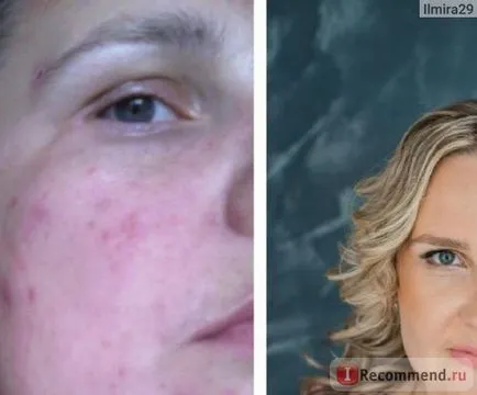 Крем demodex complex вечірній Сіньшен - «ефективне лікування демодекозу засобами demodex