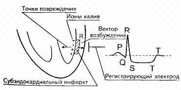 Великовогнищевий і дрібновогнищевий інфаркт міокарда (великовогнищевий) Великовогнищевий і дрібновогнищевий інфаркт міокарда