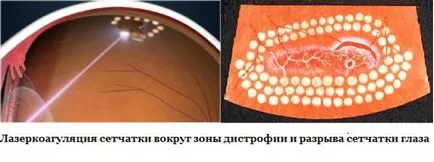 Крововилив в склеру ока - причини, симптоми і лікування (крововилив) Крововилив в склеру ока - причини, симптоми і лікування