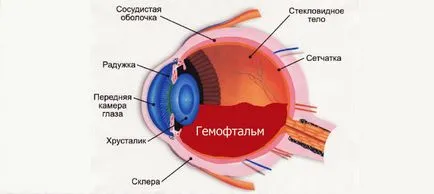 Крововилив в склеру ока - причини, симптоми і лікування (симптоми) Крововилив в склеру ока - причини, симптоми і лікування