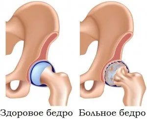 Лікування коксартрозу методом фітолазерофорез - клініка купеева (владикавказ) Лікування коксартрозу методом фітолазерофорез - клініка купеева