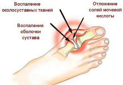 Лікування подагричного артриту класичними та народними засобами (подагричного) Лікування подагричного артриту класичними та народними засобами