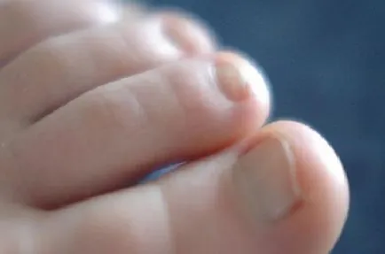 Лікування грибка нігтів ефірною олією (ефірним) Лікування грибка нігтів ефірною олією