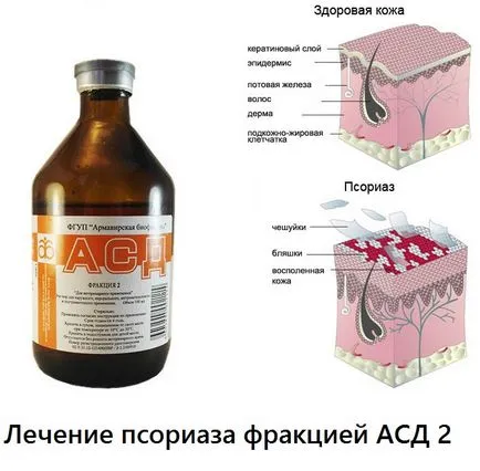 Лікування псоріазу фракцією АСД 2 - сайт про методи лікування докторів Неумивакіна, Болотова, огулова (лікування раку) Лікування псоріазу фракцією АСД 2 - сайт про методи лікування докторів Неумивакіна, Болотова, огулова