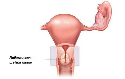 Лейкоплакія шийки матки лікування - припікання, видалення за допомогою лазера, операція, народні методи (лейкоплакія) Лейкоплакія шийки матки лікування - припікання, видалення за допомогою лазера, операція, народні методи