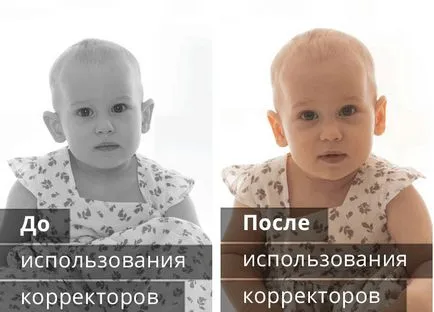 Капловухість у дітей - причини, симптоми і корекція дефекту (капловухість) Капловухість у дітей - причини, симптоми і корекція дефекту
