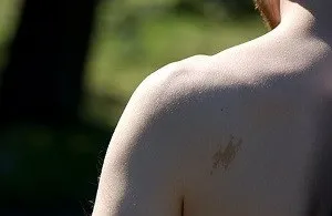 Плоскі родимки на тілі запобігти появі або видалити, спросідерматолога