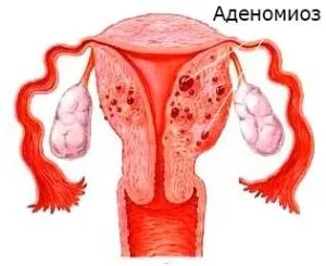 Дифузний аденоміоз матки симптоми, форми, ступеня і їх лікування (аденоміоз дифузна форма 1 ступеня) Дифузний аденоміоз матки симптоми, форми, ступеня і їх лікування