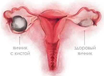 Лютеиновая кіста яєчника симптоми і лікування (кіста) Лютеиновая кіста яєчника симптоми і лікування