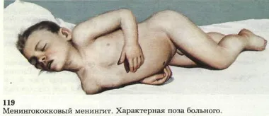 Менінгіт етіологія, патогенез, симптоми, діагностика, клініка, лікування (інфекційні хвороби) Менінгіт етіологія, патогенез, симптоми, діагностика, клініка, лікування