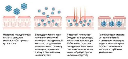 Мезотерапія від прищів відгуки, ефект, препарати, фото до і після (мезотерапія) Мезотерапія від прищів відгуки, ефект, препарати, фото до і після