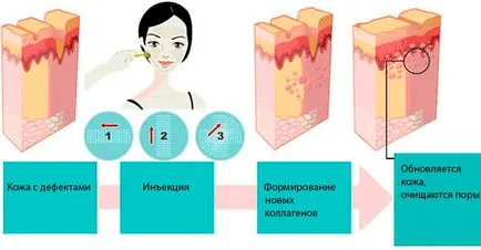 Мезотерапія від прищів відгуки, ефект, препарати, фото до і після (прищів) Мезотерапія від прищів відгуки, ефект, препарати, фото до і після