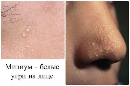 Міліуми види, причини, симптоми (фото) і лікування