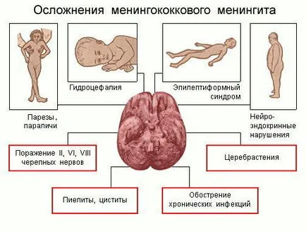 Менінгіт етіологія, патогенез, симптоми, діагностика, клініка, лікування (патогенез) Менінгіт етіологія, патогенез, симптоми, діагностика, клініка, лікування