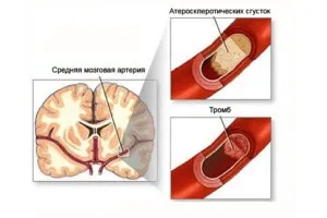 Мотивації які допоможуть кинути палити (мотивація кинути курити) Мотивації які допоможуть кинути палити