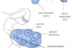 Муцинозних цистаденома яєчника причини, симптоми і лікування (гінеколог будинку) Муцинозних цистаденома яєчника причини, симптоми і лікування