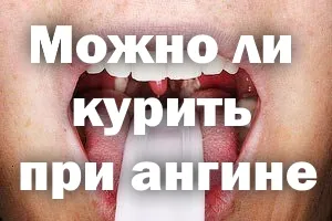 Чи можна курити при ангіні гнійної, під час, кальян, сигарети (ангіні) Чи можна курити при ангіні гнійної, під час, кальян, сигарети
