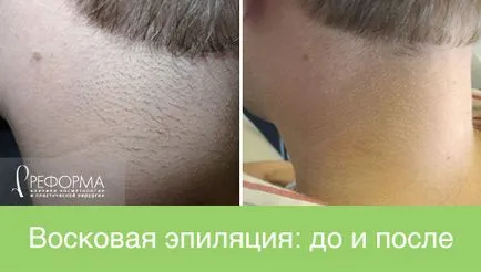 чоловіча епіляція
