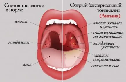 Чи можна вилікувати ангіну без антибіотиків фолікулярну, катаральну (вилікувати) Чи можна вилікувати ангіну без антибіотиків фолікулярну, катаральну