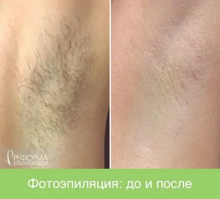 чоловіча епіляція
