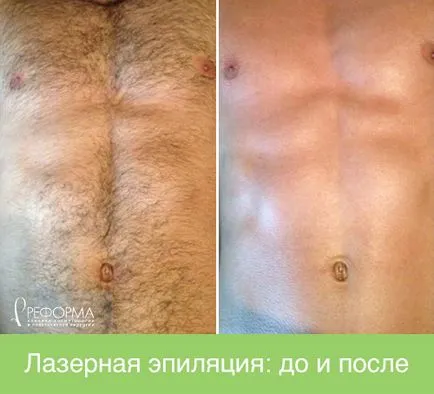 чоловіча епіляція