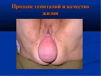 Народні засоби лікування міоми (міоми) Народні засоби лікування міоми