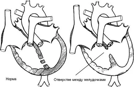 Наскільки небезпечний дефект міжшлуночкової перегородки у новонародженого (дефект міжшлуночкової перегородки у дітей) Наскільки небезпечний дефект міжшлуночкової перегородки у новонародженого