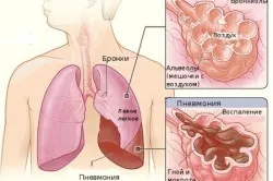 Не минає кашель після пневмонії (проходить) Не минає кашель після пневмонії