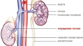 Нефроптоз, лікувальна фізкультура (вправи при нефроптоз) Нефроптоз, лікувальна фізкультура