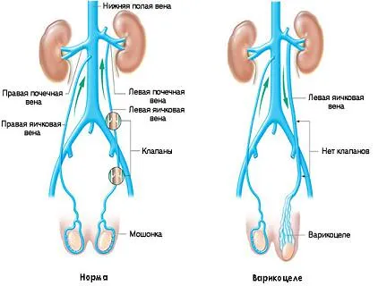 Ниючий біль в яєчках, якщо ниє яєчко, ниють яйця причини, звело яйце (ниючий біль в правому яєчку) Ниючий біль в яєчках, якщо ниє яєчко, ниють яйця причини, звело яйце