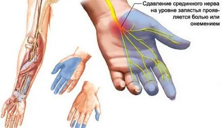 Нейропатія як розвивається, види, симптоми і лікування (лікування) Нейропатія як розвивається, види, симптоми і лікування