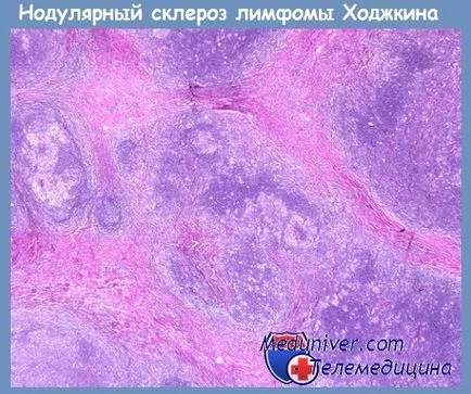 Нодулярний склероз лімфоми Ходжкіна (нодулярний склероз лімфоми Ходжкіна) Нодулярний склероз лімфоми Ходжкіна
