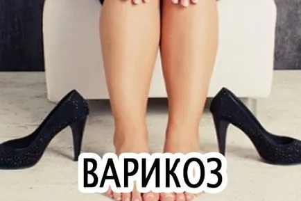 Спосіб життя при варикозі ка жити з варикозом на ногах, лікування варикозу (життя) Спосіб життя при варикозі ка жити з варикозом на ногах, лікування варикозу